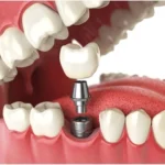 What Type of Dentist Does Implants?